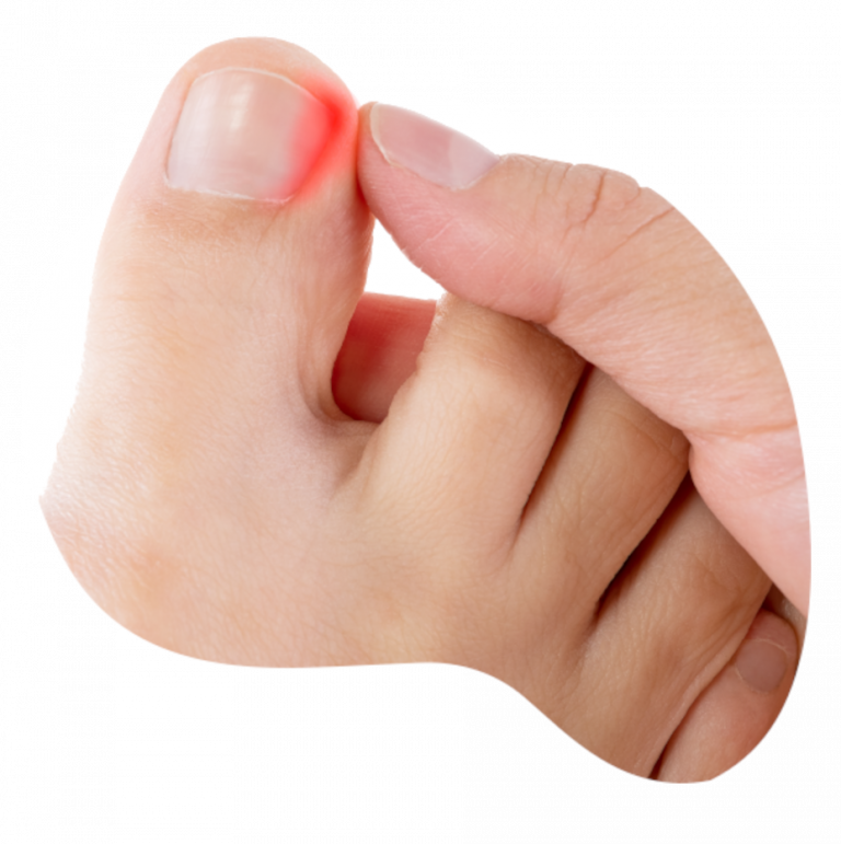 Ingrown Toenails Feetology Podiatry Centre