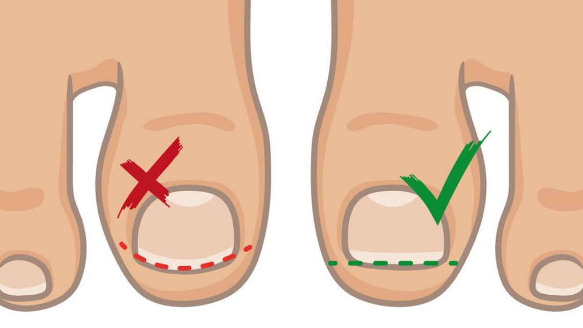 Common Myths About Ingrown Toenails Busted - Feetology Podiatry Centre